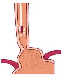 Illustratie ablatie zonder ballon