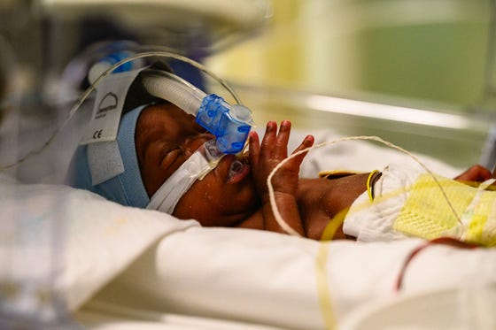 Te vroeg geboren baby krijgt extra zuurstof