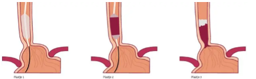 Illustratie ablatie met ballon
