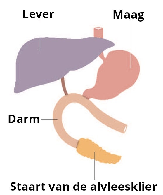 Het maag-darmstelsel na een alvleesklieroperatie: lever, maag, darm en staart van de alvleesklier. De galblaas, twaalfvingerige darm en een deel van de alvleesklier zijn verwijderd bij de operatie.
