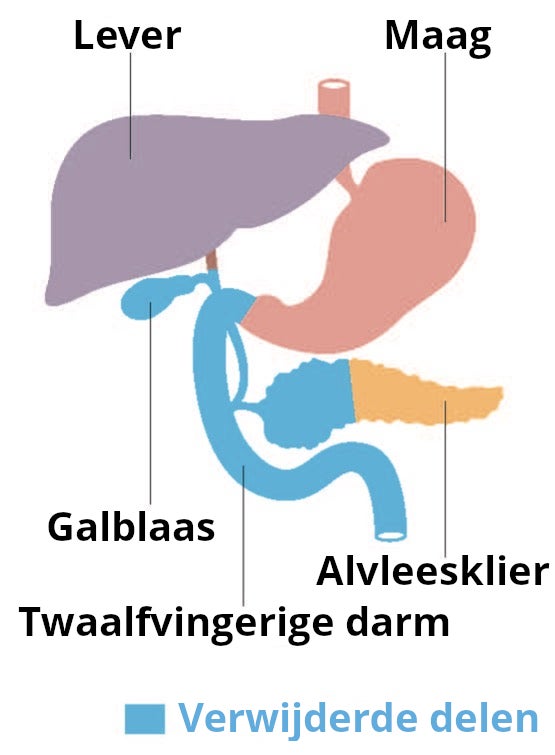 Het maag-darmstelsel voor een alvleesklieroperatie: lever, maag, galblaas, alvleesklier en de twaalfvingerige darm. De galblaas, twaalfvingerige darm en een deel van de alvleesklier zijn blauw gekleurd om aan te geven dat deze onderdelen worden verwijderd bij de operatie.