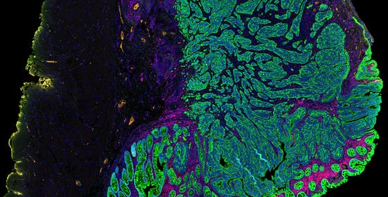 Microscopische opname van een darmtumor die net getransformeerd is naar kwaadaardig 