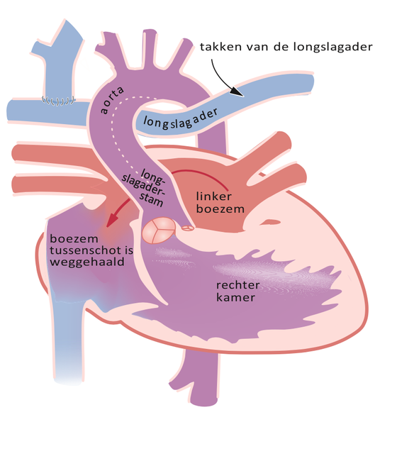 Schematische weergave van het hart na de Glenn operatie bij hypoplastisch linkerhartsyndroom.