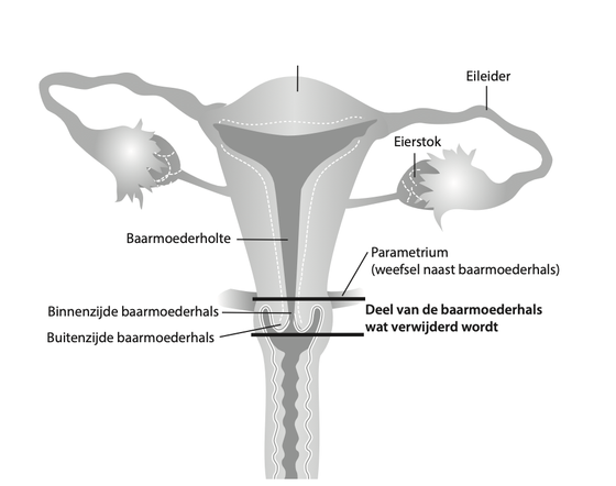 Baarmoederhalskanker