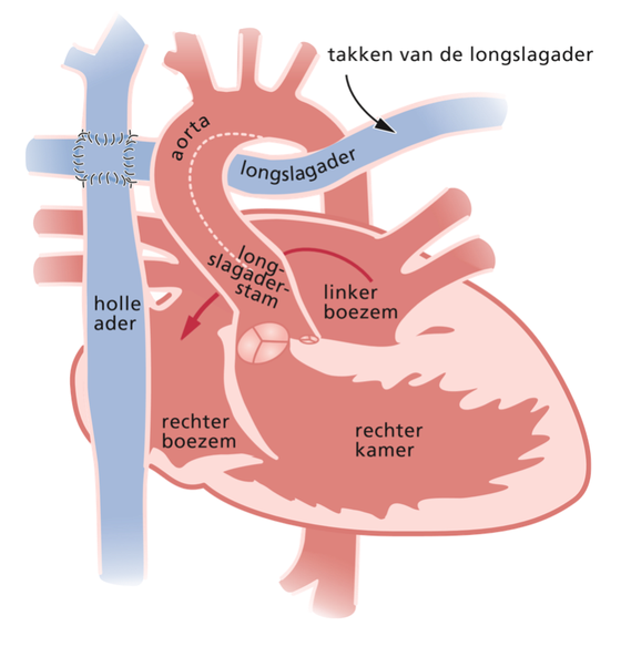 Schematische weergave van het hart na de Fontan operatie bij hypoplastisch linkerhartsyndroom.