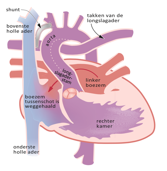 Schematische weergave van het hart na de Norwood operatie bij hypoplastisch linkerhartsyndroom.