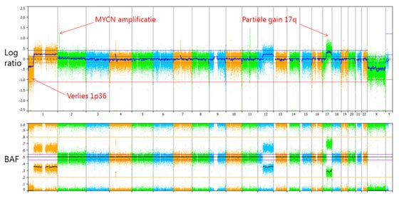 Voorbeeld van een SNP-array analyse van een neuroblastoom met verlies van chromosoom 1p36, amplificatie van MYCN en gedeeltelijke verhoging van chromosoom 17q.