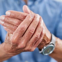 Male hand with rheumatoid arthritis complaints