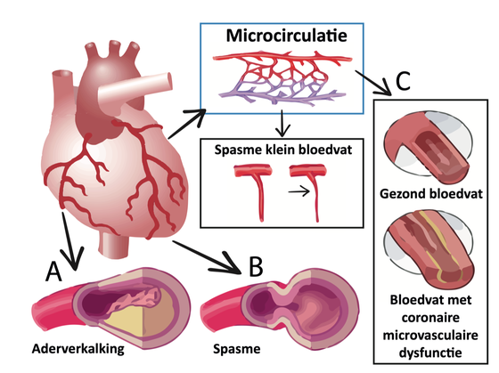Coronaire vaatdysfunctie